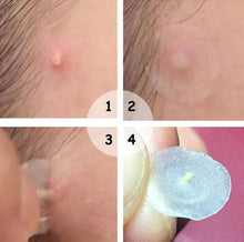 Load image into Gallery viewer, Skin Tag & Acne Patch 24 PCS